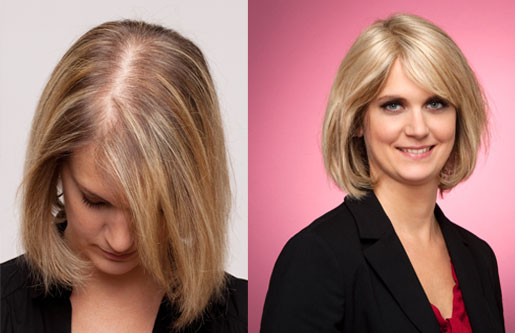 Women's hair loss  Hairfax